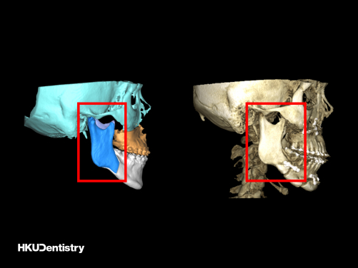 矢狀支骨切開術: （左）術前虛擬手術計劃（紅框）;（右）術後CT掃描顯示使用鈦金屬板和螺絲進行內部固定（紅色框）。
 